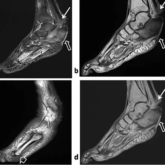 mri right heel with contrast
